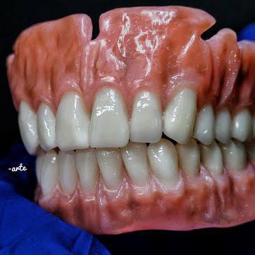 Complete Dentures