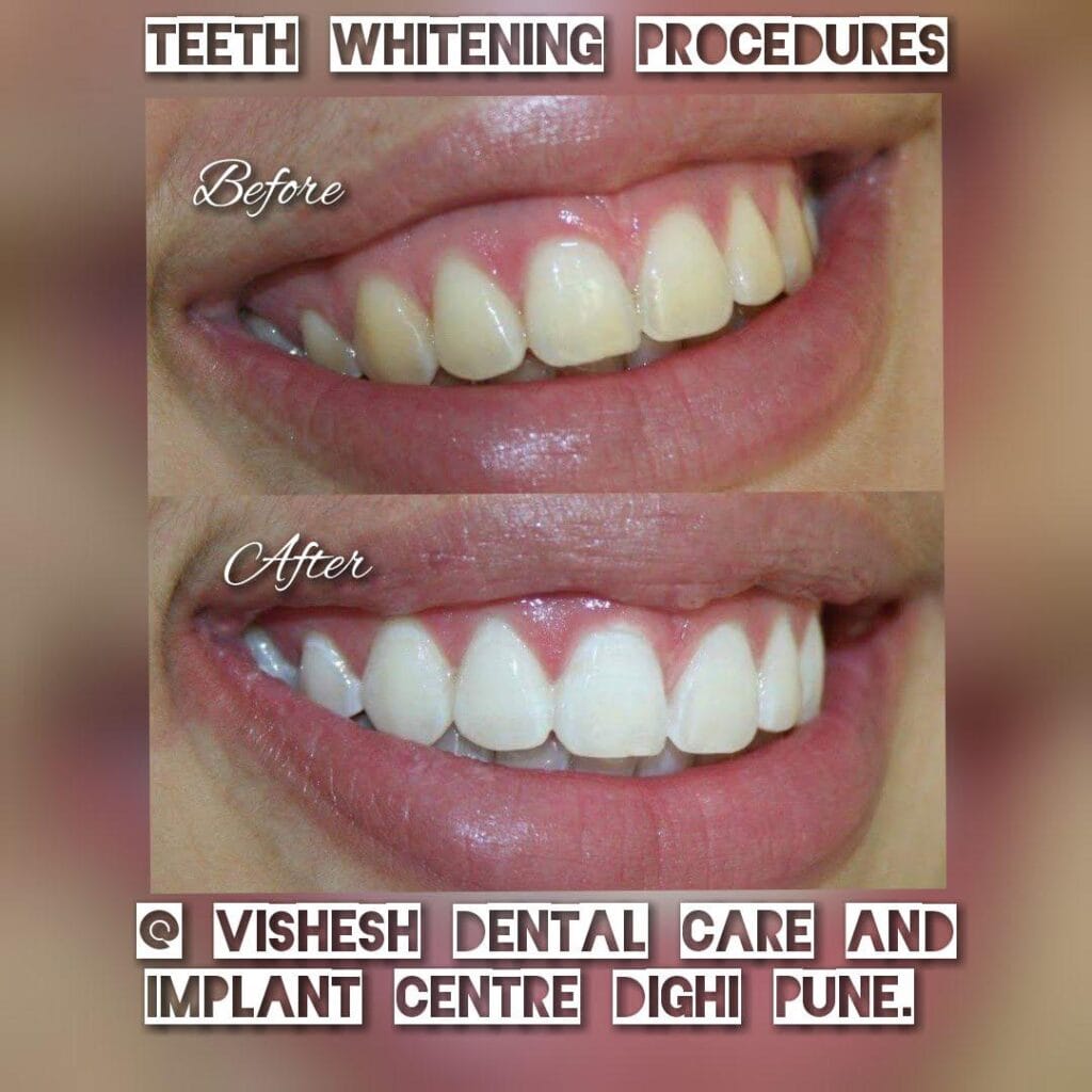 Teethwhitening